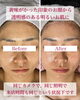 「くすみ知らず！見違える透明感【福井市/ハーブピーリング/肌質改善エステ】」