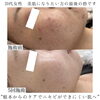 「ハーブ劇的ビフォーアフター(ニキビ・ニキビ跡編)【 福井フェイシャルエステ/ 福井美肌/ 福井ハーブピーリング 】」