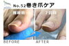 No.52巻き爪ケア「矯正中でも出せる爪」２「No.52巻き爪ケア「矯正中でも出せる爪」」