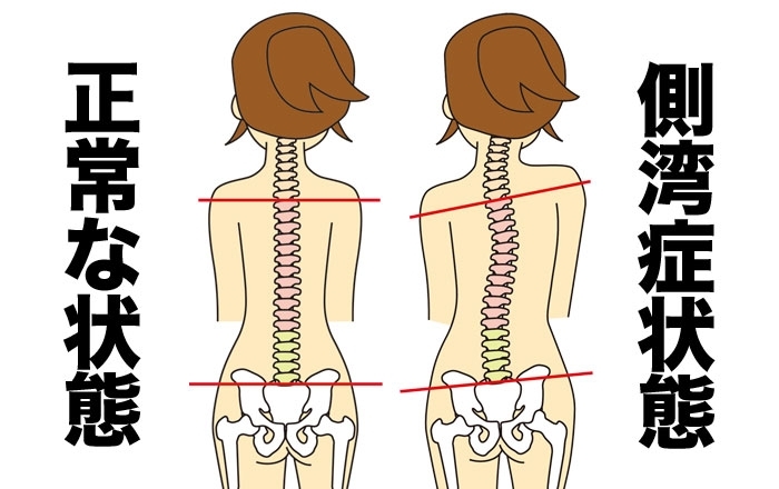 骨盤のゆがみが原因の場合が多いです。「「側弯症」の原因は…？予防策や治す方法は…？」