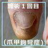 No.61お爪再生コース施術事例４「No.61お爪再生コース（爪甲鉤彎症）の施術事例」