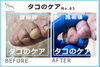 たこのケア事例No.85-3「もう指はいらないとさえ思った。たこのケア事例No.85」