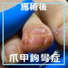 No.81あーこれ巻き爪じゃなくて爪甲鉤彎症５「No.81あーこれ巻き爪じゃなくて爪甲鉤彎症なんですよ」