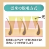 「脱毛方式の違い」
