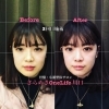 小顔矯正（3回目）「【小顔矯正ビフォーアフター③】」