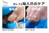 No.51陥入爪「角が痛くて爪が伸ばせない」２「No.51陥入爪「角が痛くて爪が伸ばせない」」