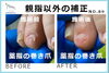 薬指の矯正写真４「薬指も巻き爪の矯正が出来ますか？」