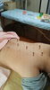 「過敏性腸症候群（IBS）」