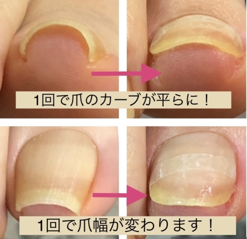 巻爪びよ ん でも痛くないんです Nail Foot Care Private Salon Macaron マカロン のニュース まいぷれ 松江 巻爪びよ ん でも痛くないんです Nail Foot Care Private Salon Macaron マカロン のニュース まいぷれ 松江