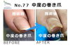 No.77　中度の巻き爪のケア１回目２「No.77　中度の巻き爪のケア１回目」