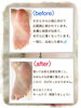 皮膚むしり症とフットケア「皮膚むしり症とフットケア」