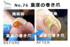 No.76　重度の巻き爪のケア１回目２「No.76　重度の巻き爪のケア１回目」