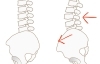 骨盤前傾②「腰椎すべり症の原因と最も効果的な改善法とは？【腰痛・坐骨神経痛・整体・那須塩原・大田原】」
