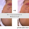 「針を使わず、電気の力で美容成分浸透！１０年来のお客様から大人気！［プライベートサロンanoa］［倉敷フェイシャルエステ］」