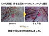 頭皮のビフォーアフター「マイクロスコープから見た発毛状況の紹介」