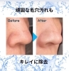 頑固な毛穴の黒ずみもスッキリ「水素水ピーリング「ハイドロスプラッシュ」で毛穴洗浄ケア」