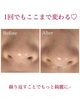 「毛穴隠すの終わり【ハーブピーリング/福井/エステ】」