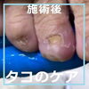 たこのケア事例No.85-5「もう指はいらないとさえ思った。たこのケア事例No.85」