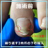 施術前「今の巻き爪ケアに満足していますか？ No.107」