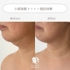 ビフォーアフター「【人気急上昇】脂肪溶解 × 筋膜リフトで二重アゴ・たるみの徹底ケア！」