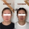 すっきり小顔に！自信あふれる表情へ「5回の小顔施術でここまで変化！ビフォーアフターのご紹介」