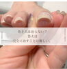 100%は治りません。「巻き爪ケア」