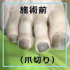 No.55爪切りの施術事例３「No.55爪切りの施術事例」