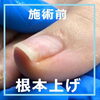 「巻き爪のおすすめのケア「根本上げ」」