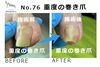 No.76　重度の巻き爪のケア１回目５「No.76　重度の巻き爪のケア１回目」