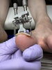 お爪周りのケア後巻きを牽引「巻き爪ケア」