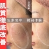 【肌質改善】短期集中！トラブル肌予防・ニキビケア・開き毛穴改善：初回体験