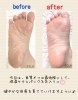 その後の経過は…？「【皮膚むしり症】続編・3ヶ月後の様子♪【フットケア】」
