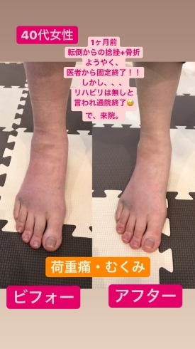 この むくみは衝撃でしょ 京都市南区 整体 骨折リハビリ 京都整体 匠のニュース まいぷれ 京都市西京区 南区 この むくみは衝撃でしょ 京都市南区 整体 骨折リハビリ 京都整体 匠のニュース まいぷれ 京都市西京区 南区