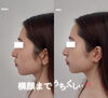 ハリ、ツヤも上がります♡「しっかりと引き上げて美しいフェイスラインへ【福井市ハイフ/福井市エステ/ハイフ/小顔】」