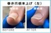 巻き爪根本上げ（左）「重度の足爪トラブル専門アクアベイル」