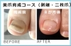 美爪育成コース「重度の足爪トラブル専門アクアベイル」