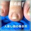 人差し指１ヶ月後-3「人差し指１ヶ月後、キレイに改善されてネイルも可能 No.96」