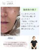 「ほうれい線とたるみの変化をわかりやすく＊ソニックエステ12回の施術例」