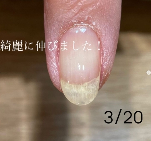 装甲剥離のお客さまの例です 福島区ネイル Nail By Kisimiiruのニュース まいぷれ 大阪市福島区 装甲剥離のお客さまの例です 福島区ネイル Nail By Kisimiiruのニュース まいぷれ 大阪市福島区