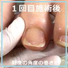 巻き爪は“軽度のうち”がチャンス！-4「巻き爪は“軽度のうち”がチャンス！」