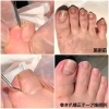 巻き爪の施術と巻き爪矯正テープの施術例。「足の専門サロン FIRST STEP」