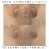 「劇的ビフォーアフター毛穴編【福井毛穴サロン/福井毛穴汚れ/福井復元フェイシャル】」
