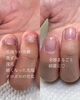 「むしり癖&噛み癖【福井/自爪育成/深爪】」