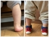 裸足の時に内倒れしていたかかとが靴を履くことでまっすぐに「Pedinico」