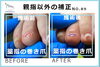 薬指の矯正写真３「薬指も巻き爪の矯正が出来ますか？」