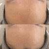 「直後から圧倒的な満足感を実感し美肌へ【福井毛穴サロン/福井毛穴の開き/福井美白サロン】」