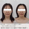 「劇的ビフォーアフター（両頬編）【福井エステサロン/福井小顔/福井ハーブピーリング/福井ハイフ】」