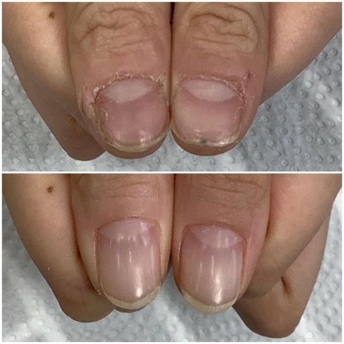 育成卒業 噛み癖のある爪でも憧れの縦爪に 福井市 ネイルサロン 自爪育成 Nail Melia Medical Healthcare のニュース まいぷれ 福井 育成卒業 噛み癖のある爪でも憧れの縦爪に 福井市 ネイルサロン 自爪育成 Nail Melia Medical Healthcare のニュース まいぷれ 福井