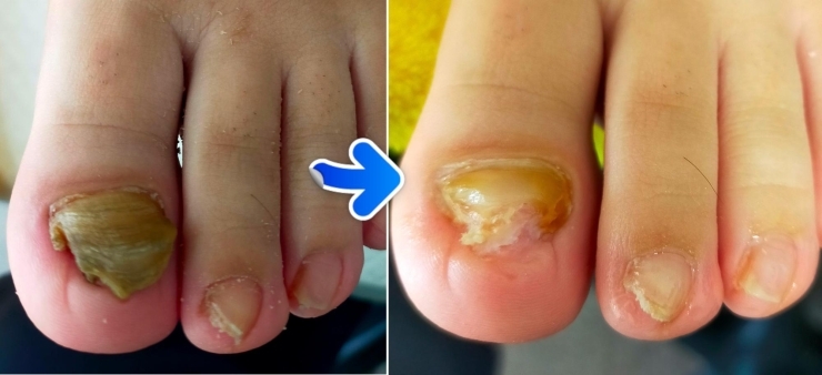 肥厚爪怖くない ドクターネイル爪革命奈良のニュース まいぷれ 橿原 肥厚爪怖くない ドクターネイル爪革命奈良のニュース まいぷれ 橿原