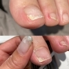 巻き爪　補正根元上げ